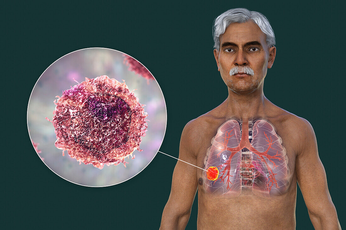 Lungs affected by lung cancer, illustration