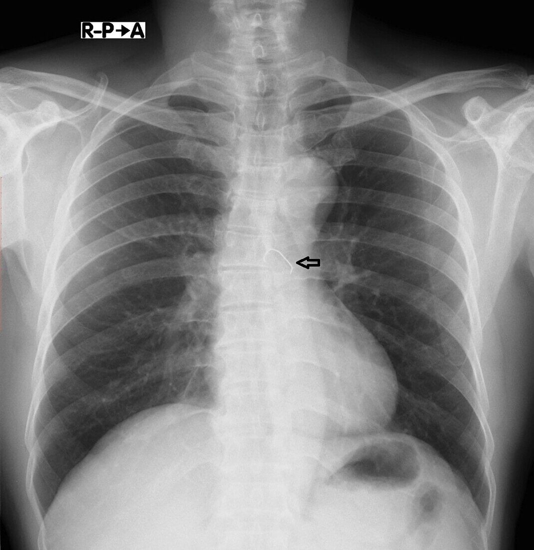 Swallowed denture, X-ray