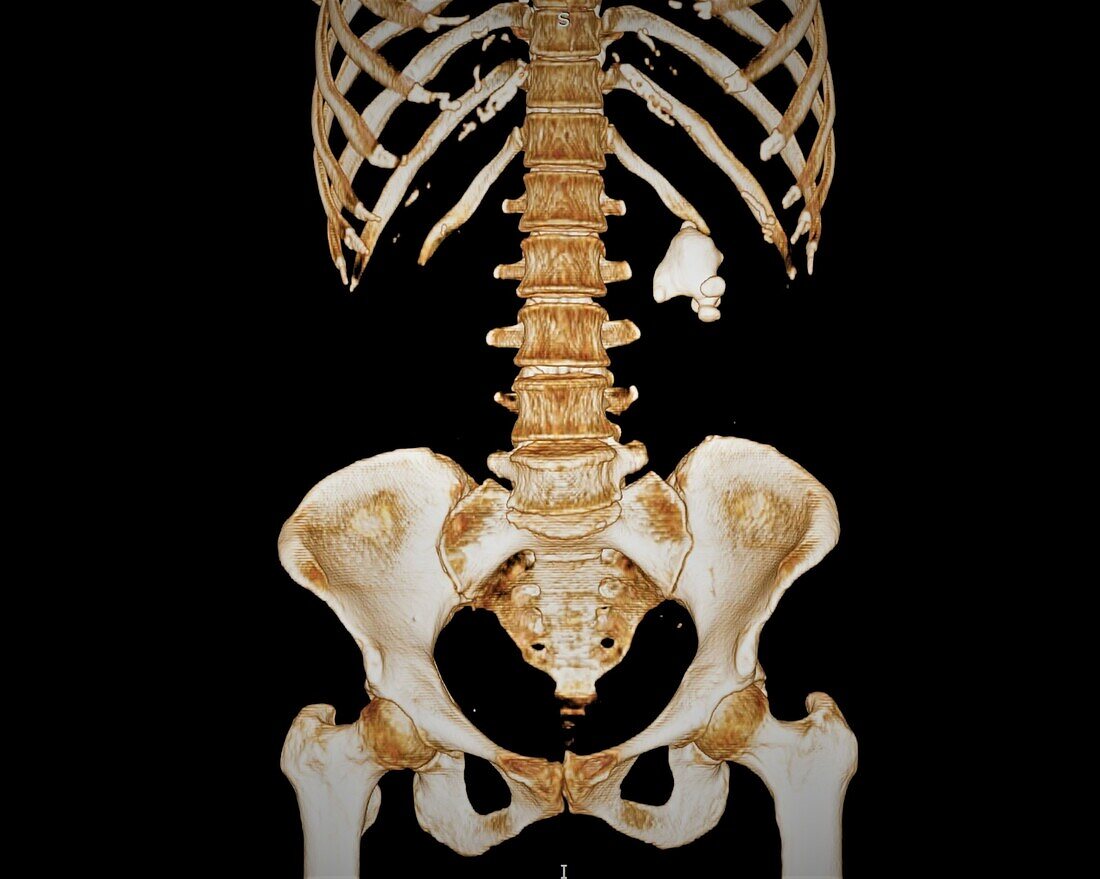 Kidney stone, 3D CT scan