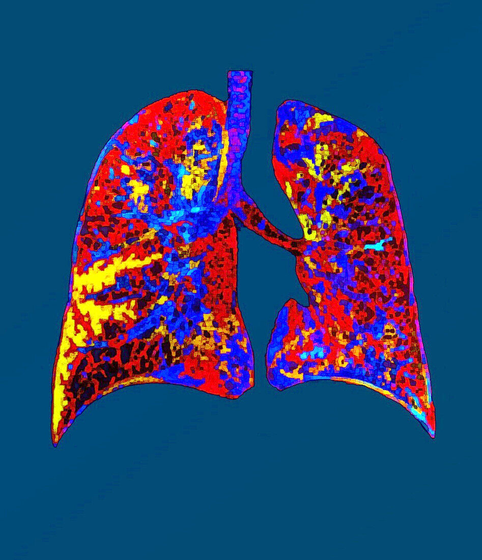 Healthy lungs, CT scan