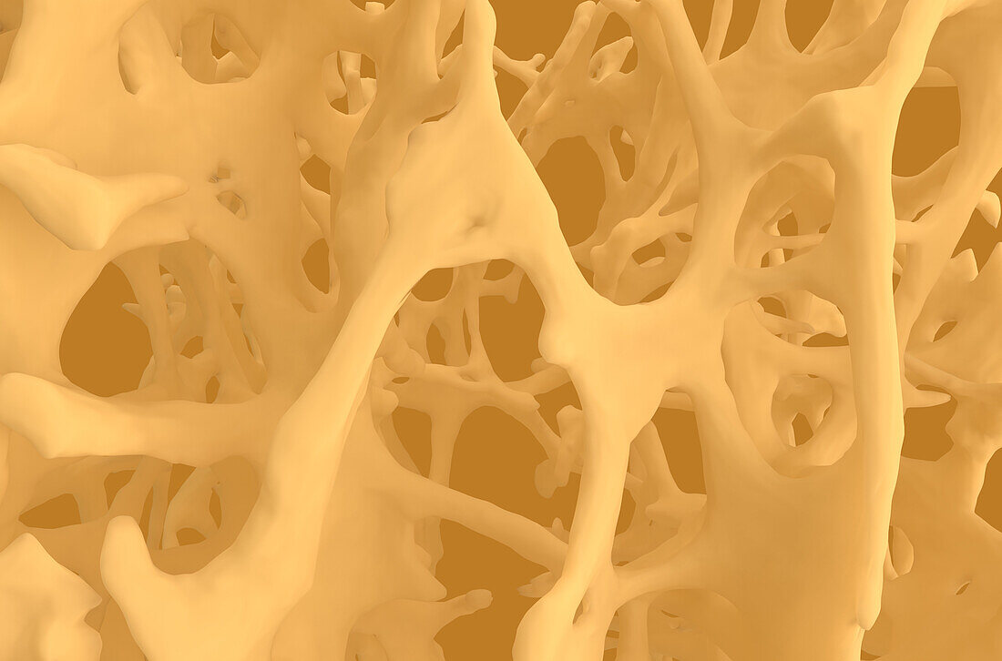 Osteoporotic bone tissue, illustration