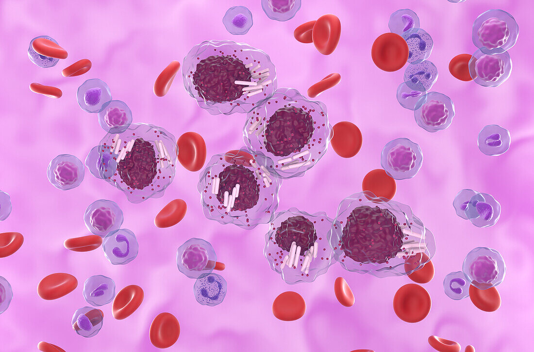 Auer rods in acute promyelocytic leukaemia, illustration