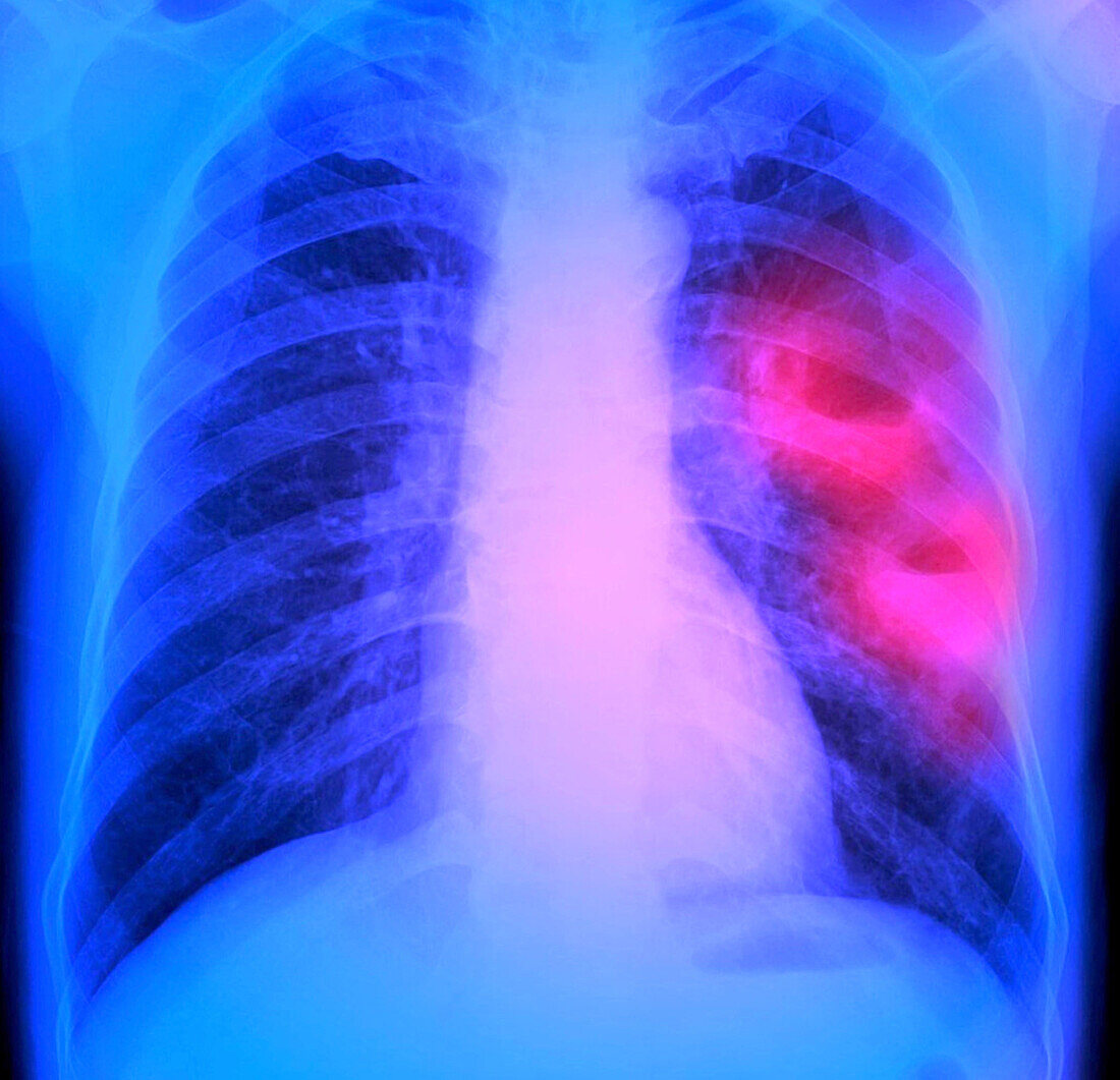 Lung abscesses, X-ray