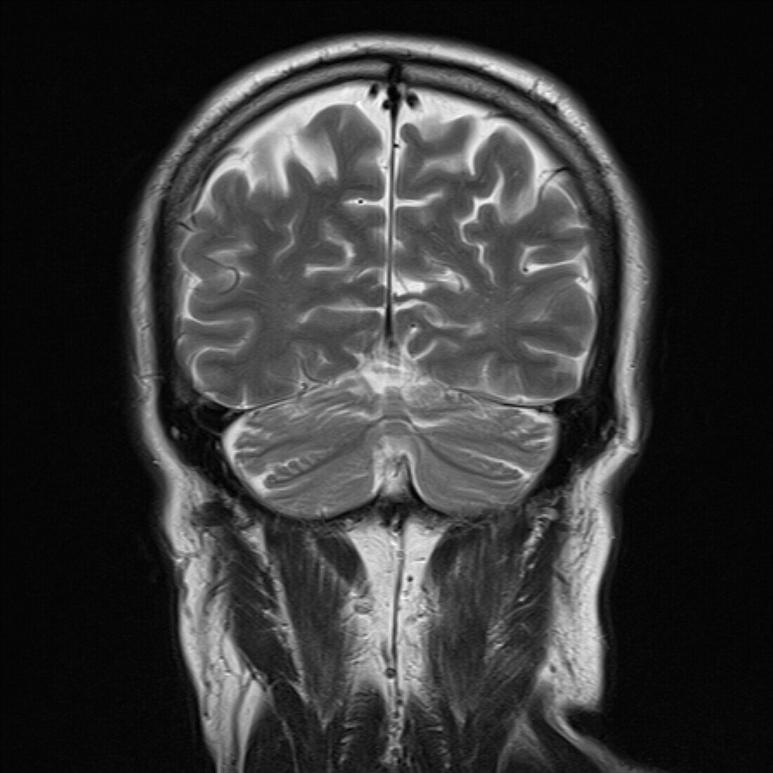 Healthy brain, MRI scan