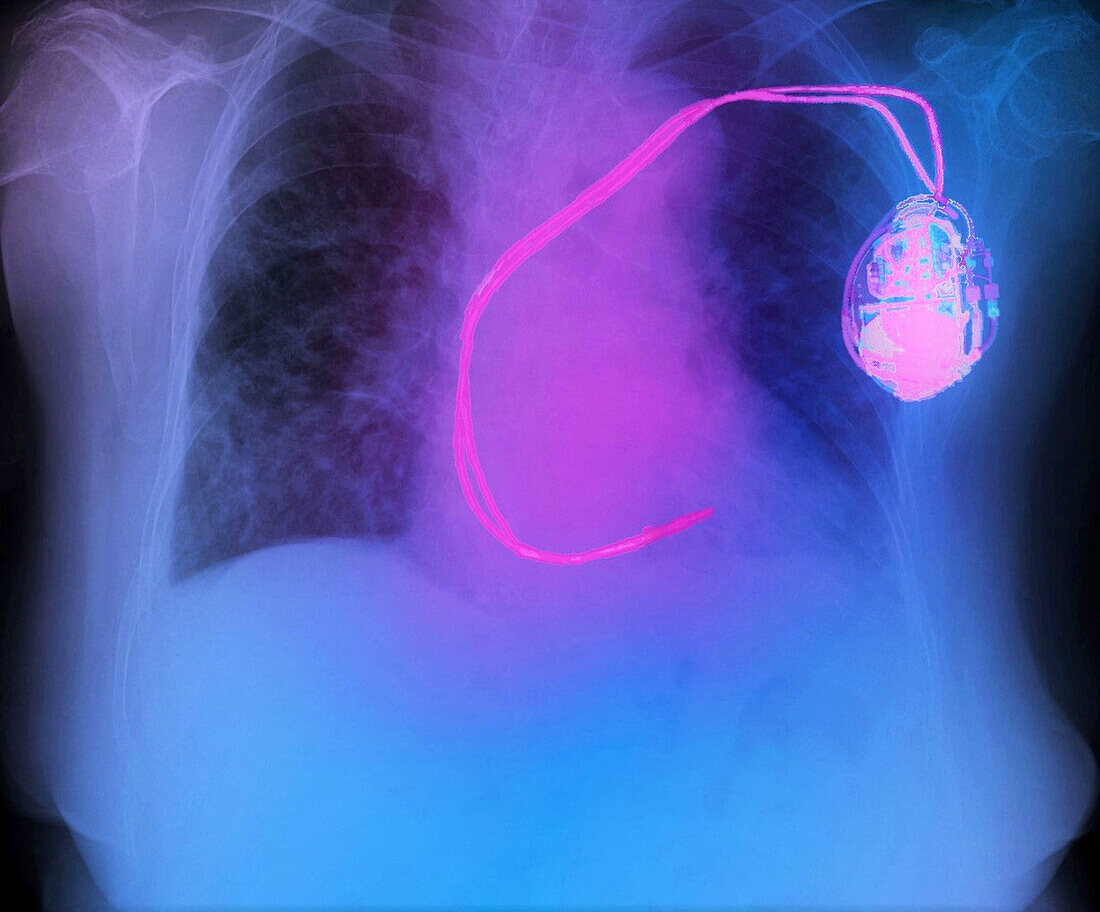 Pacemaker, X-ray