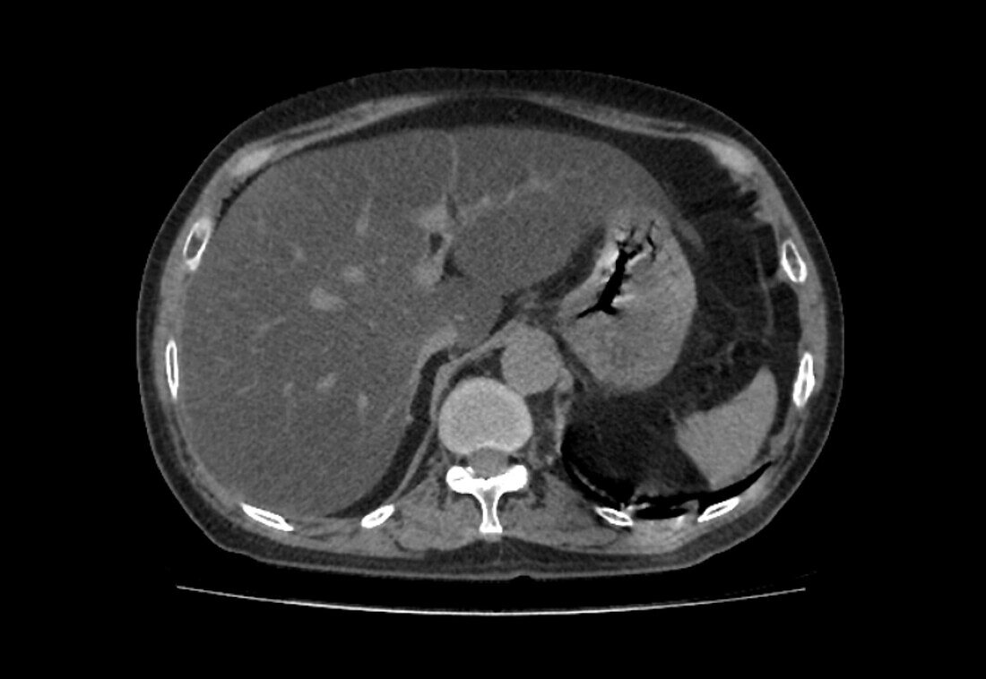 Fatty liver, CT scan
