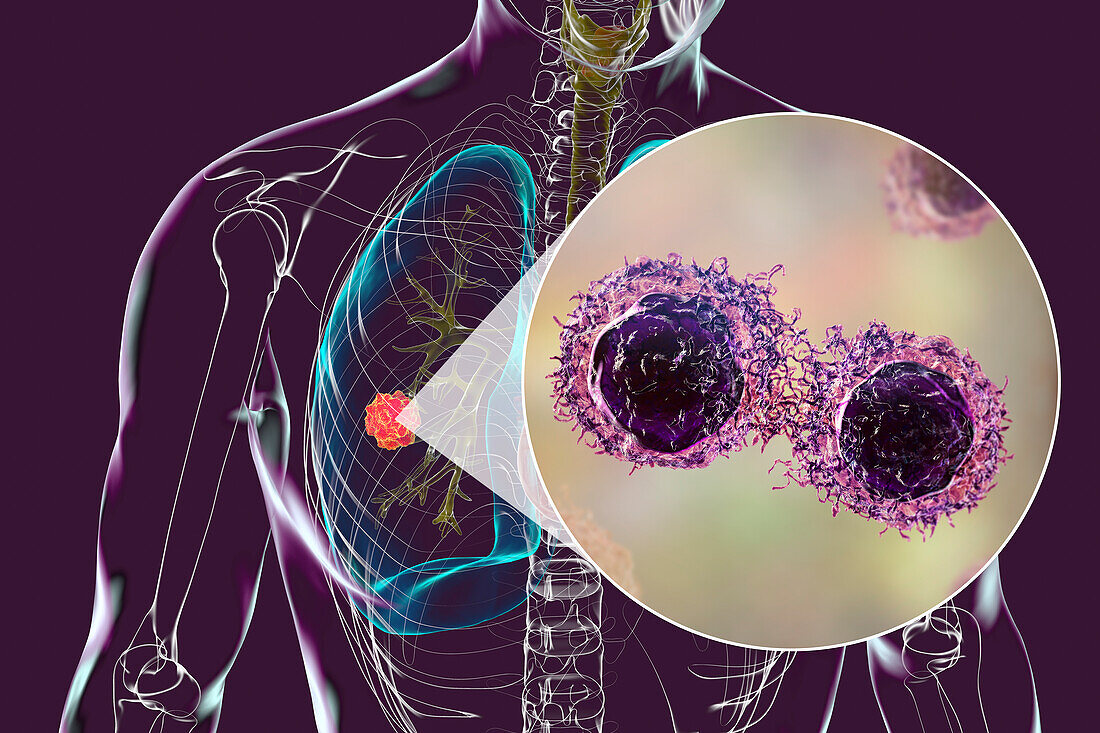 Lung cancer tumour and malignant cells, illustration