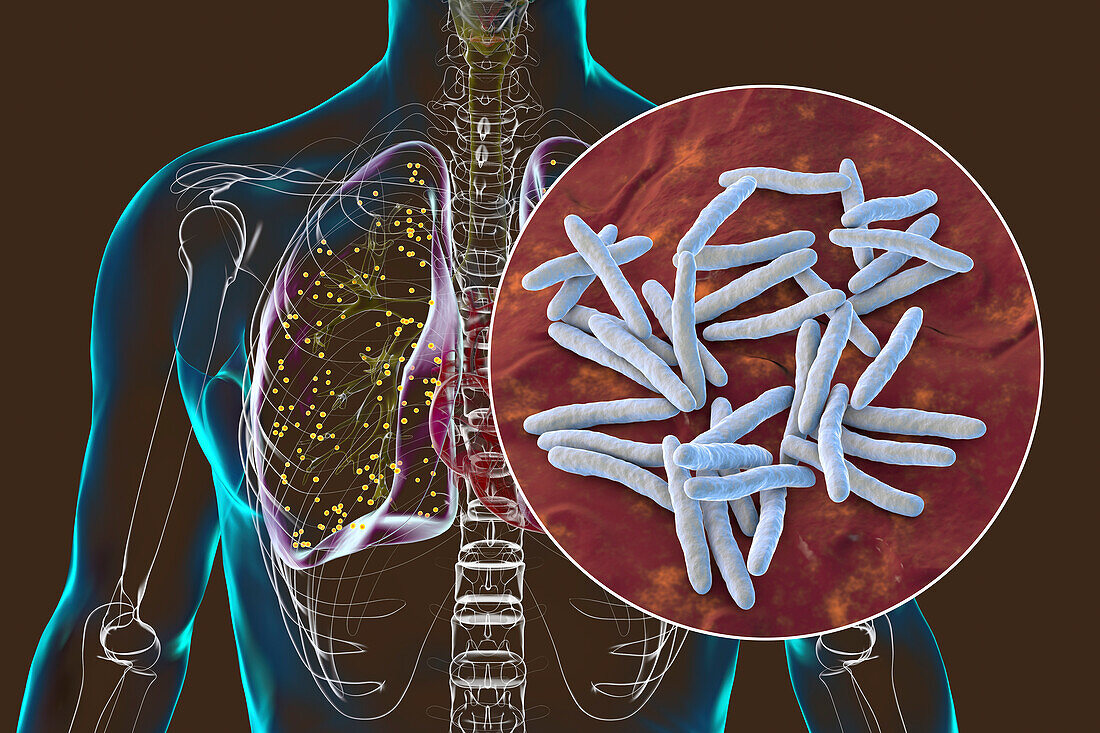 Lungs affected by miliary tuberculosis, illustration