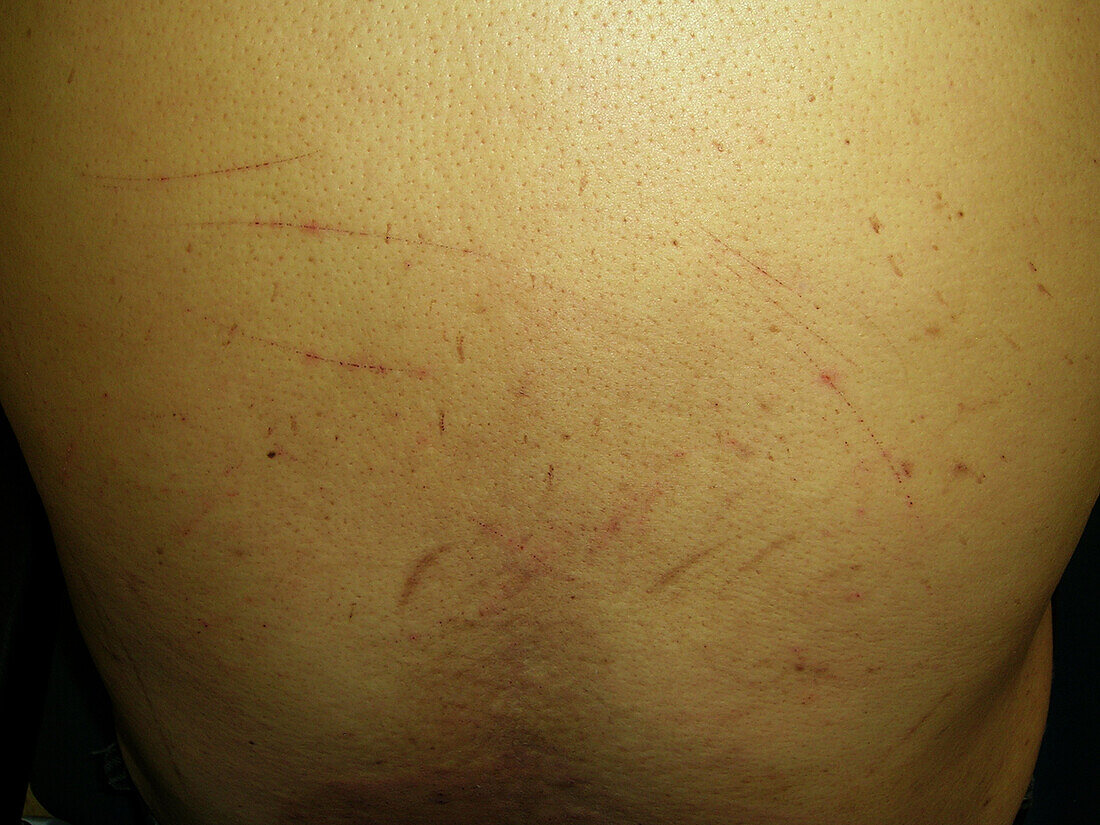 Scratches in patient with jaundice