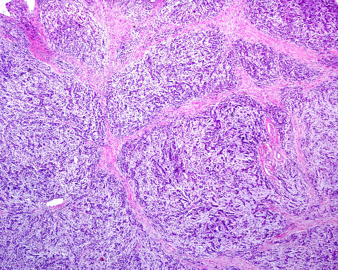 Pleomorphic adenoma in submaxillary gland, light micrograph