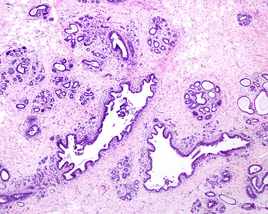 Breast adenosis, light micrograph