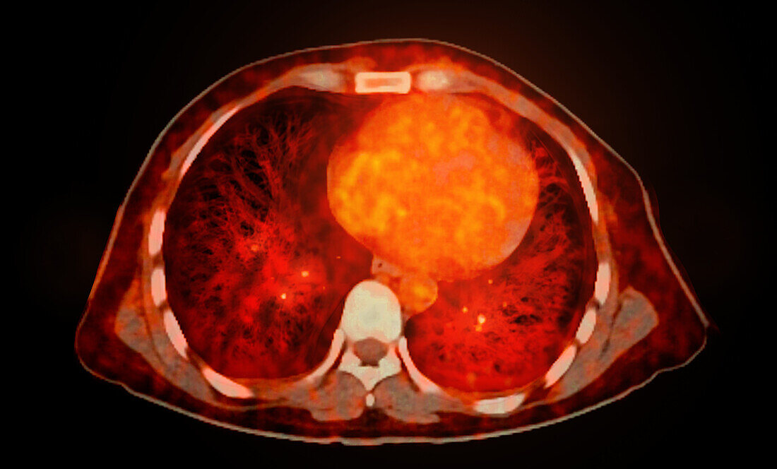 Healthy chest, CT-PET scan