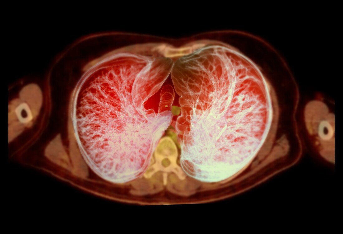 Healthy chest, CT-PET scan