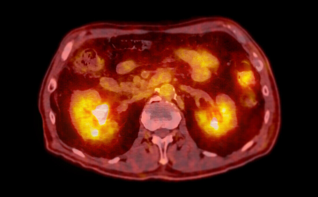 Normal abdomen, CT-PET scan