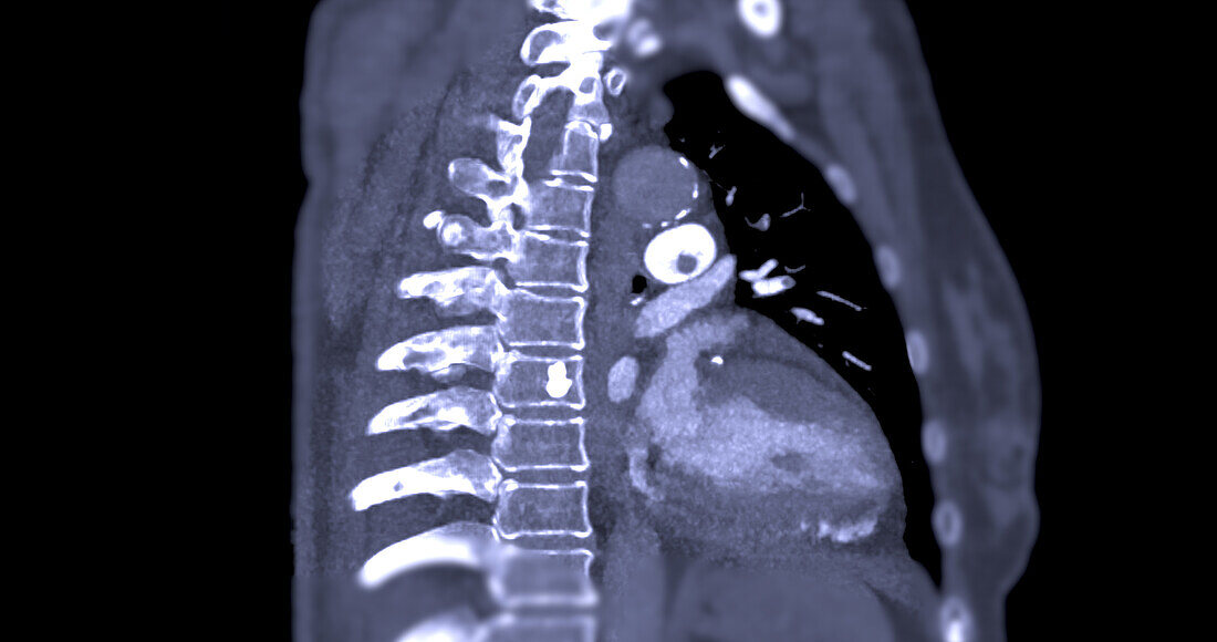 Pulmonary embolism, CT scan