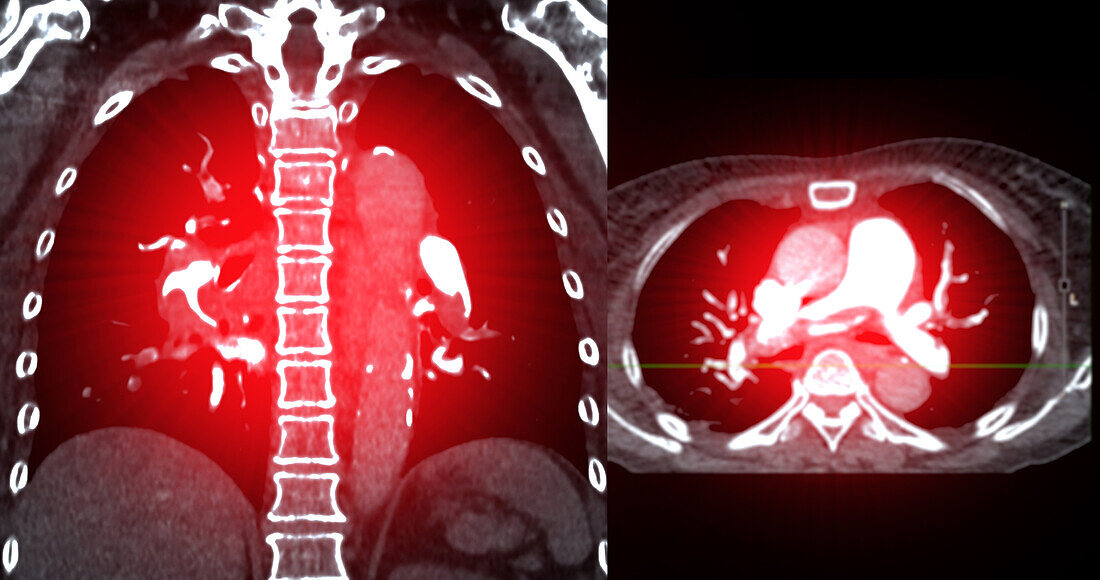 Pulmonary embolism, CT scans