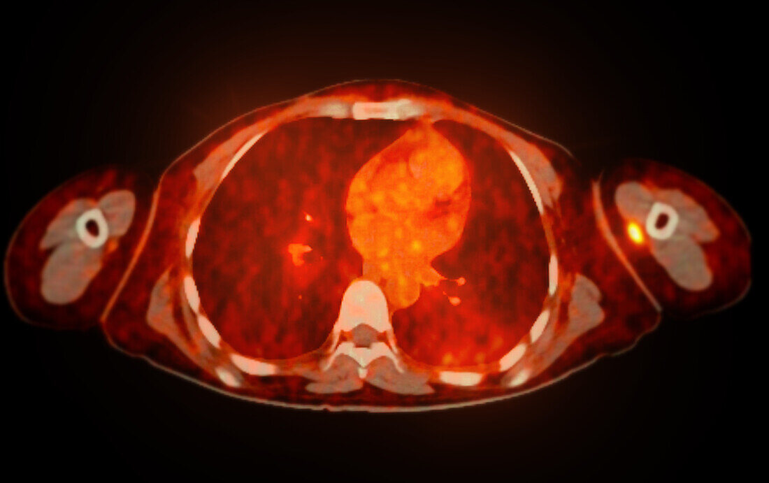 Normal abdomen, CT-PET scan