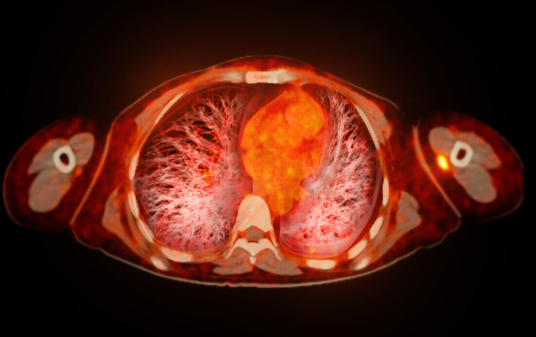 Normal abdomen, CT-PET scan