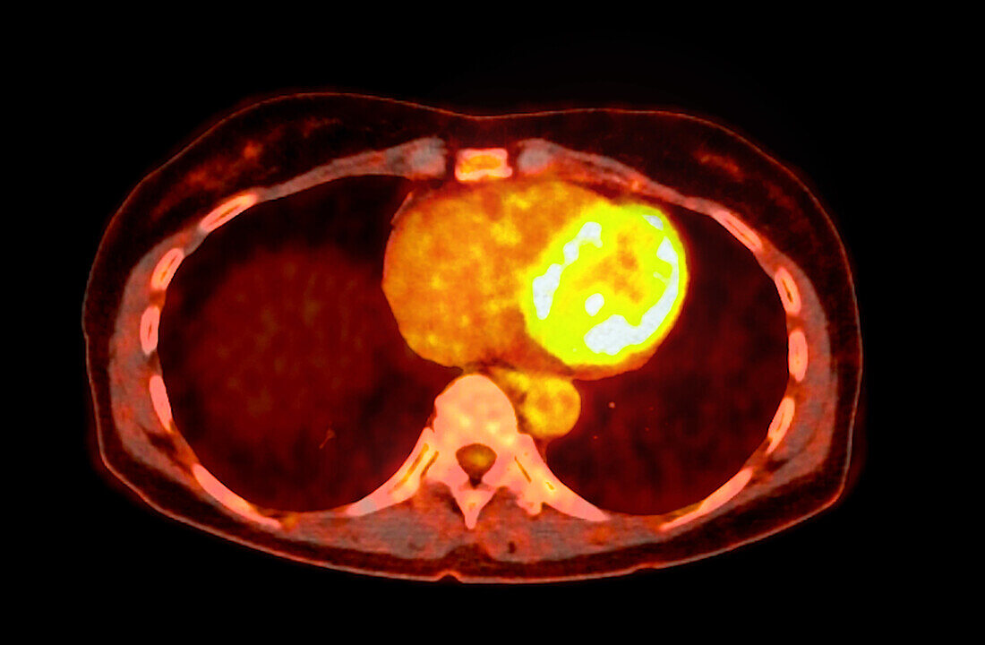 Normal chest, CT-PET scan