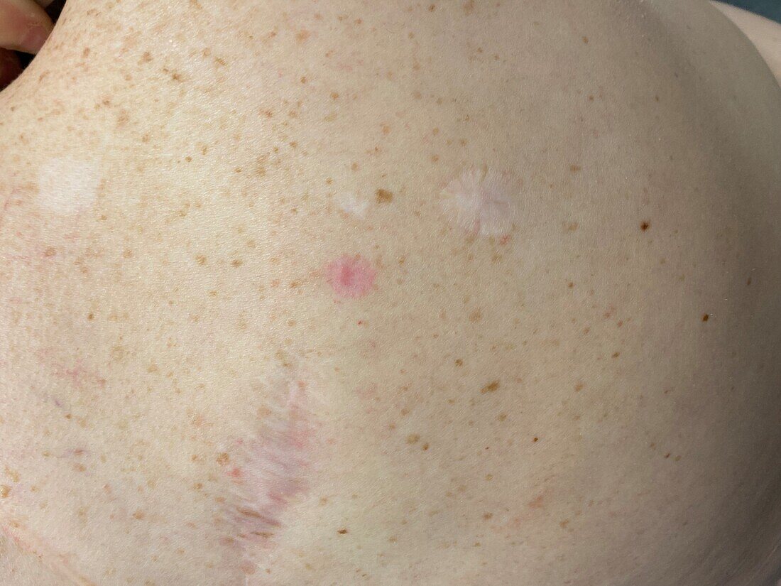 Scar from superficial basal cell carcinoma biopsy