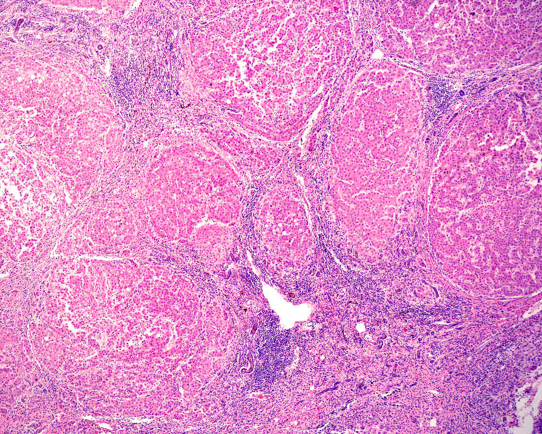 Cirrhosis, light micrograph