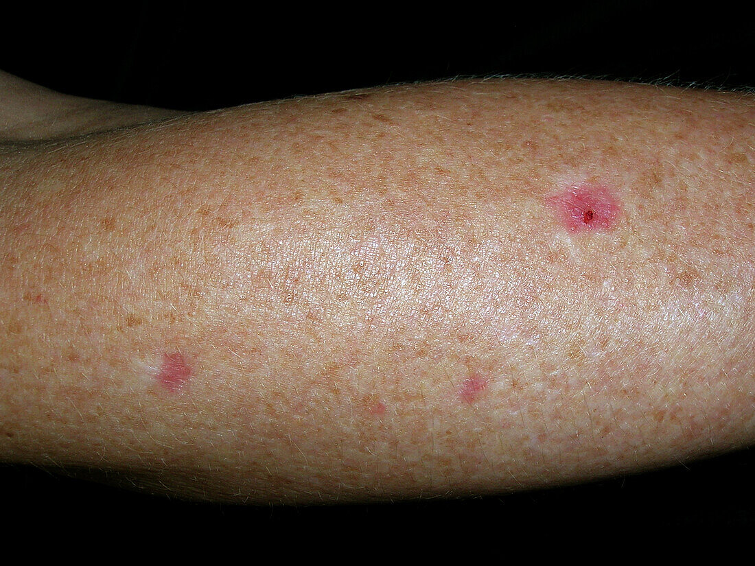 Superficial basal cell carcinomas