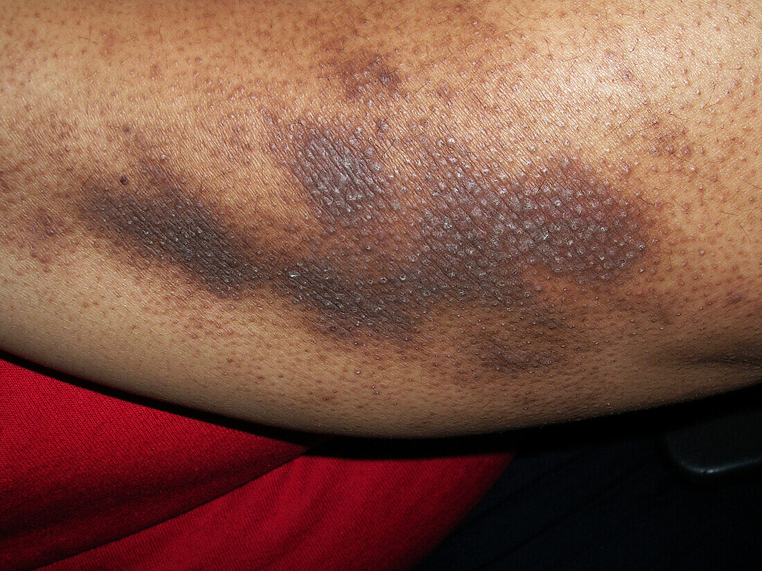 Papular eczema