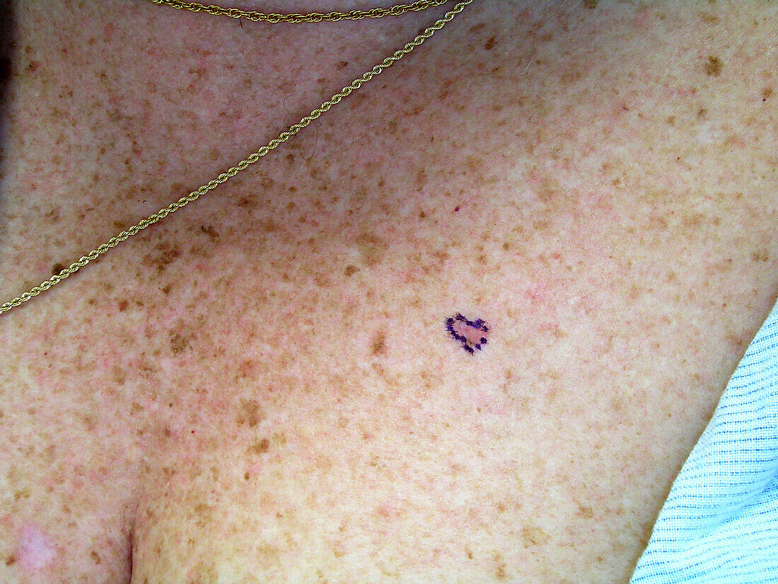 Nodular superfical basal cell carcinoma