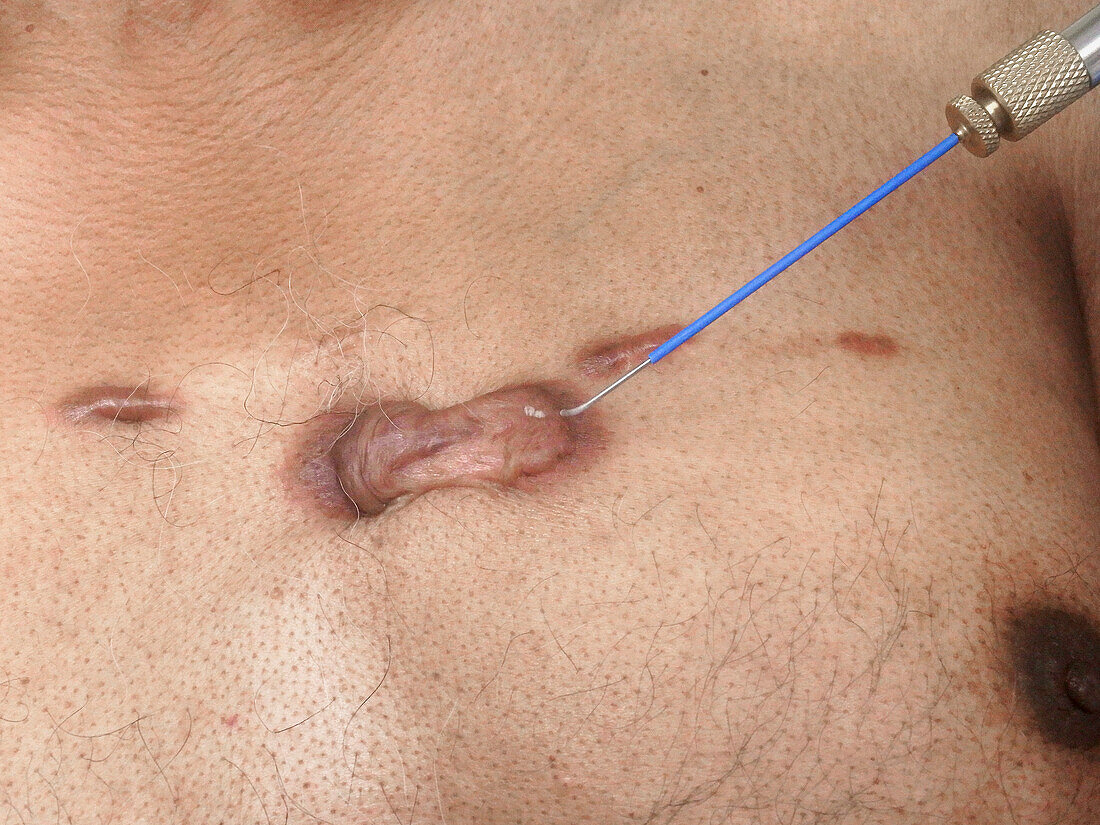 Cryosurgery of keloid scars