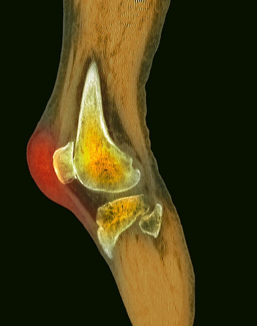 Haematoma, CT scans