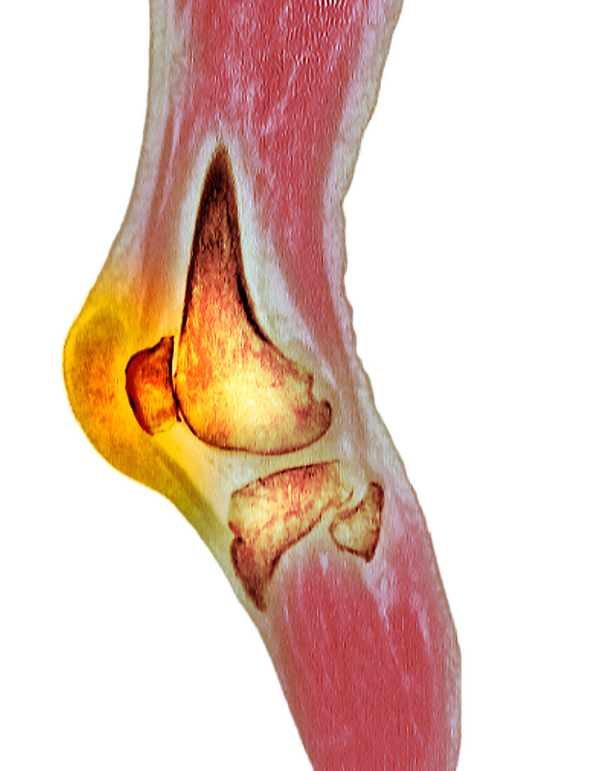 Haematoma, CT scan