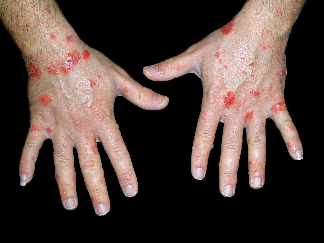 Dyshidrotic and nummular eczema