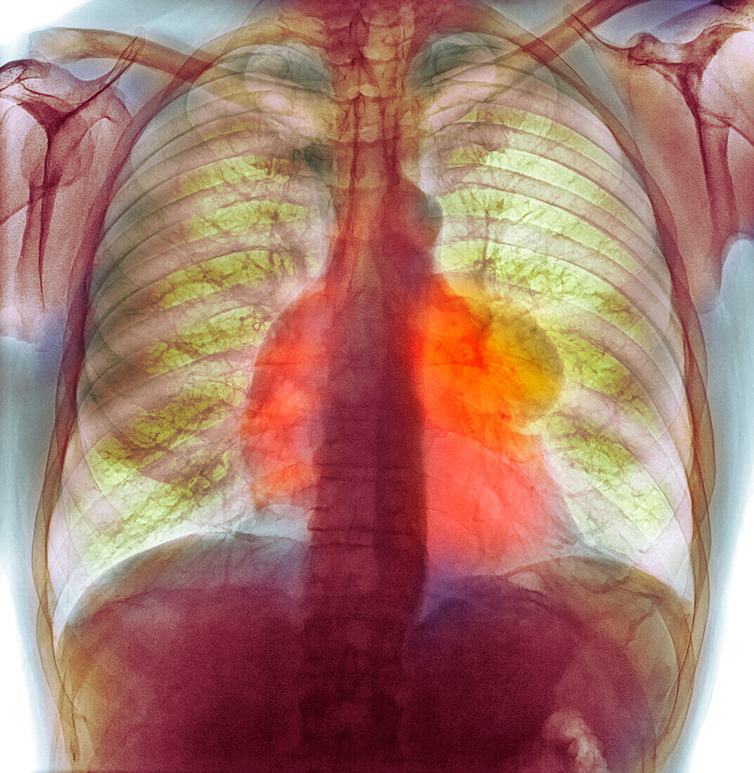 Thymus gland cancer, X-ray