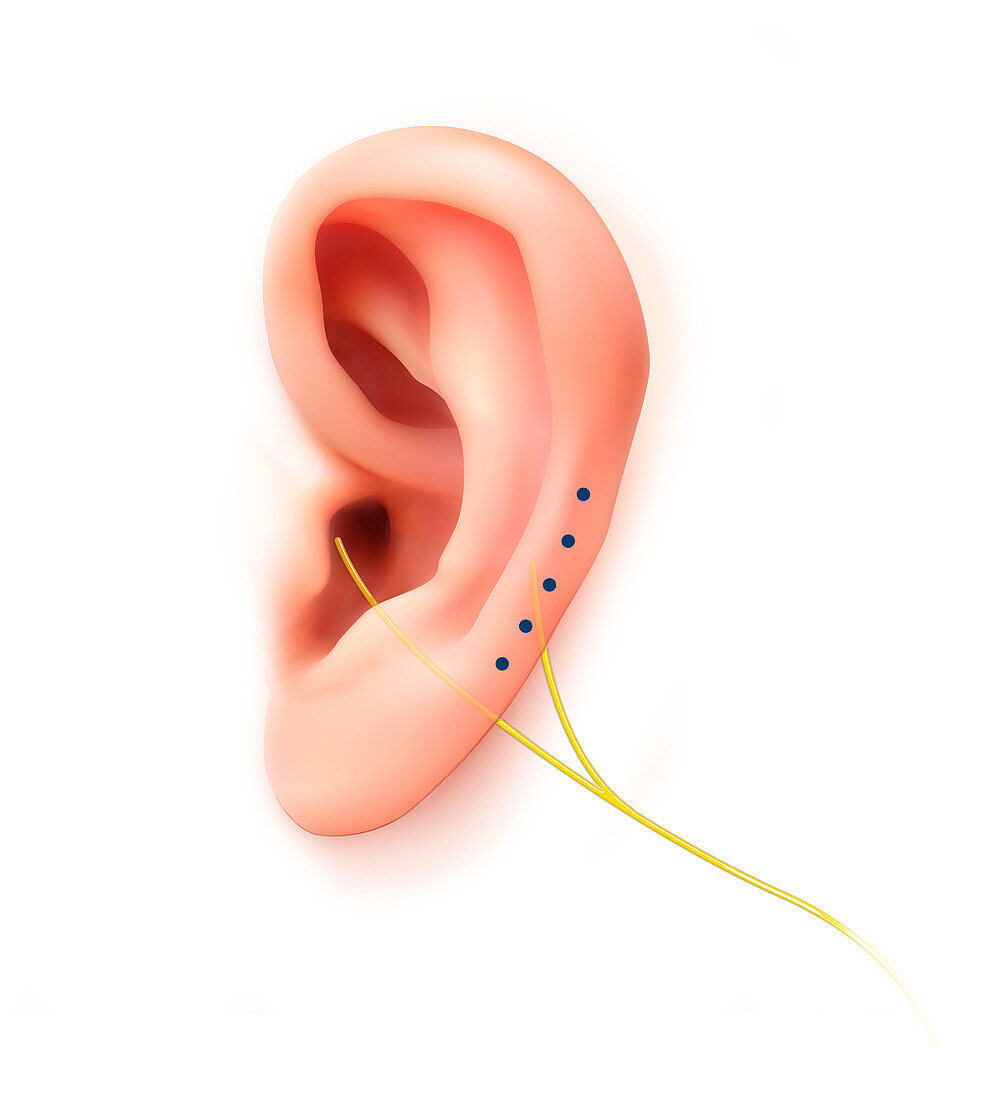 Vagus nerve stimulation, conceptual illustration