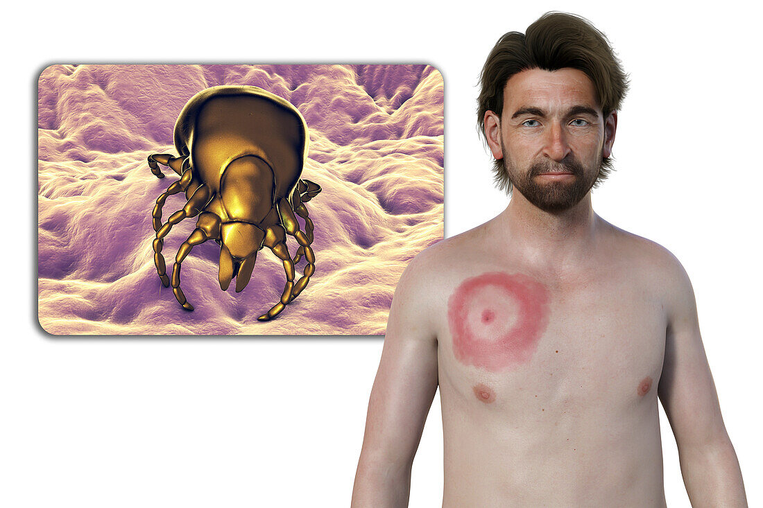 Man with erythema migrans from Lyme disease, illustration