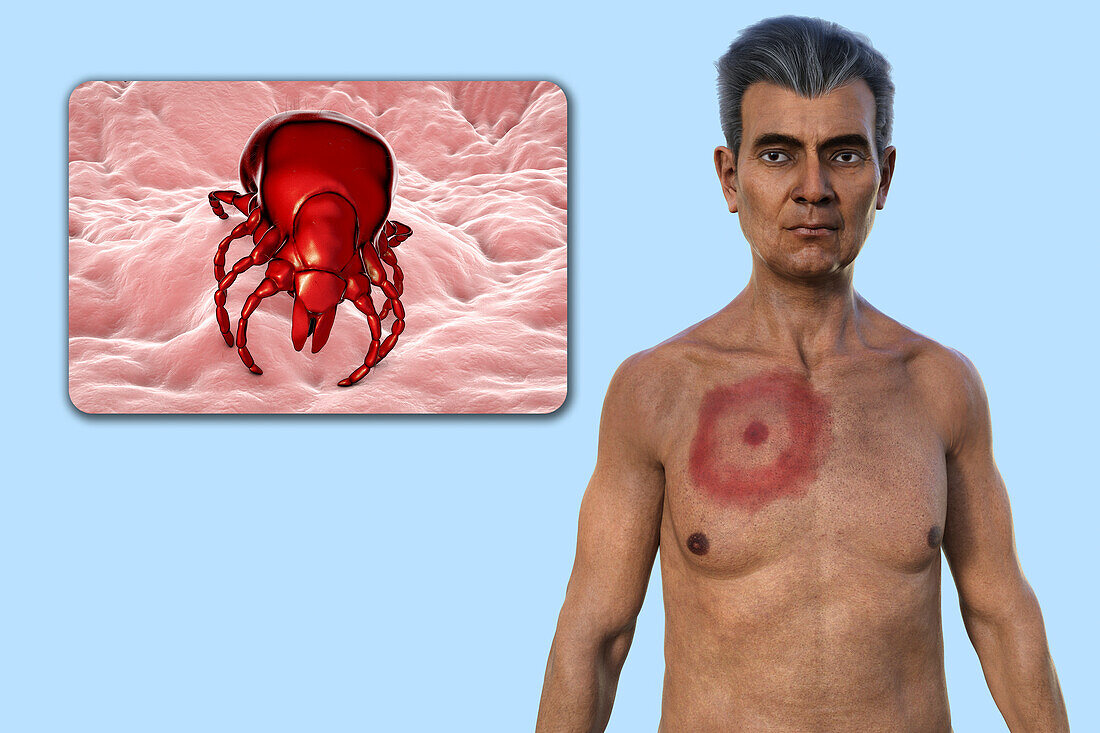 Man with erythema migrans from Lyme disease, illustration