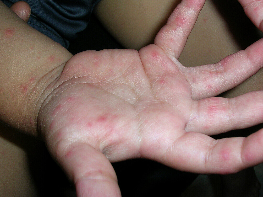 Hand foot and mouth disease