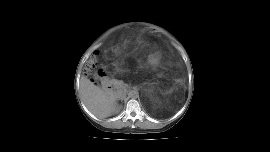 Abdomen liposarcoma, CT scan