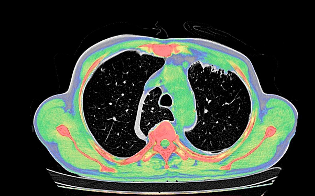 Azygos lobe, CT scan