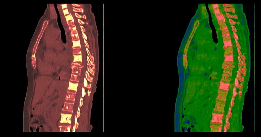 Bone cancer, CT scan