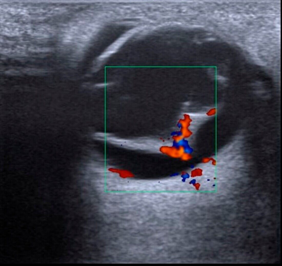 Detached retina, ultrasound scan