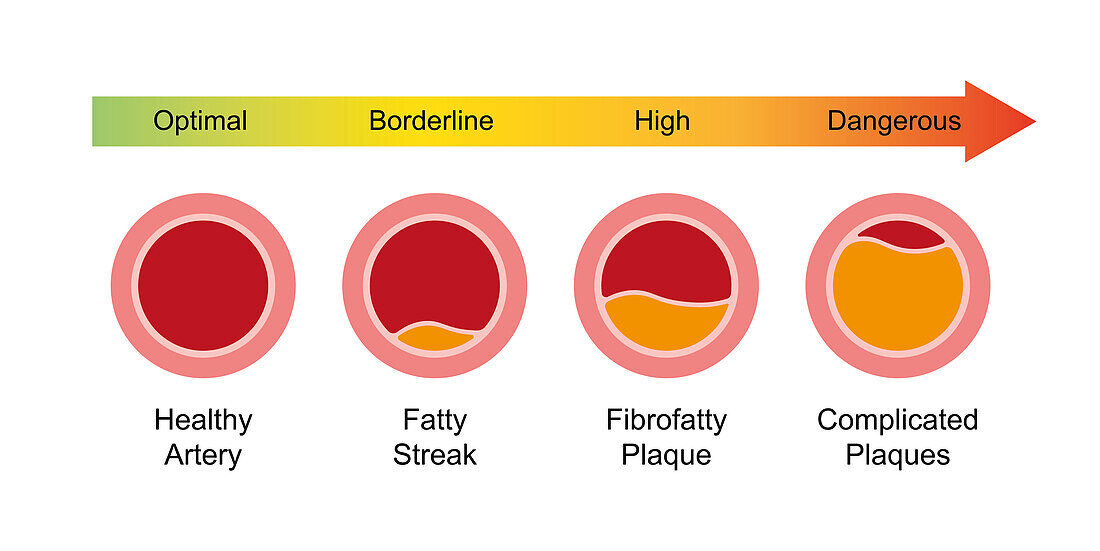 Atherosclerosis stages, illustration