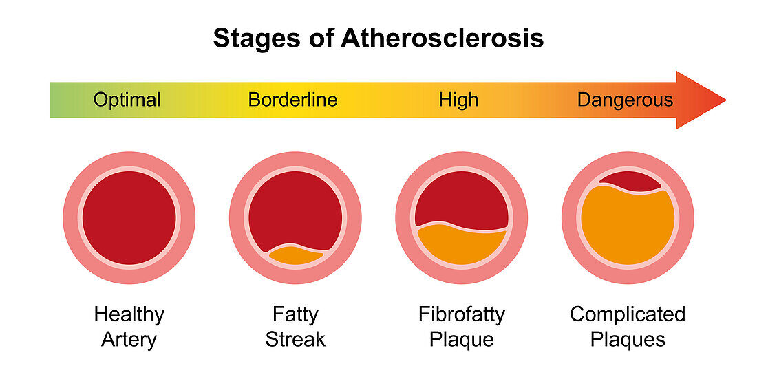 Atherosclerosis stages, illustration