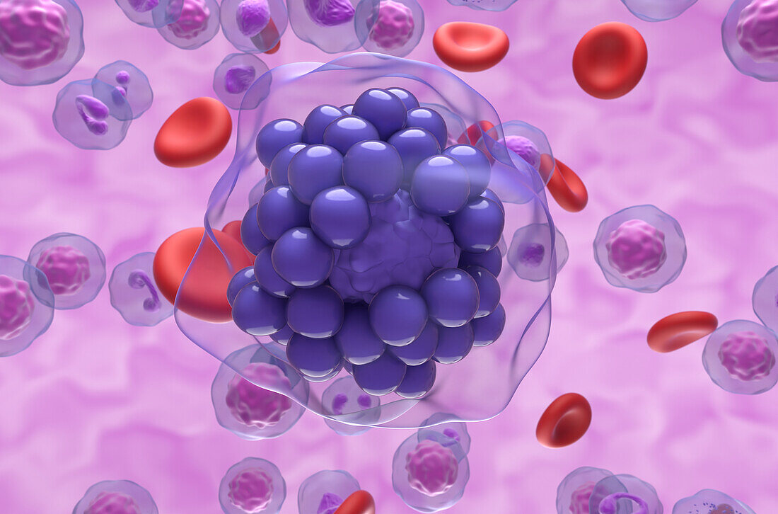 Diffuse large B-cell lymphoma, illustration