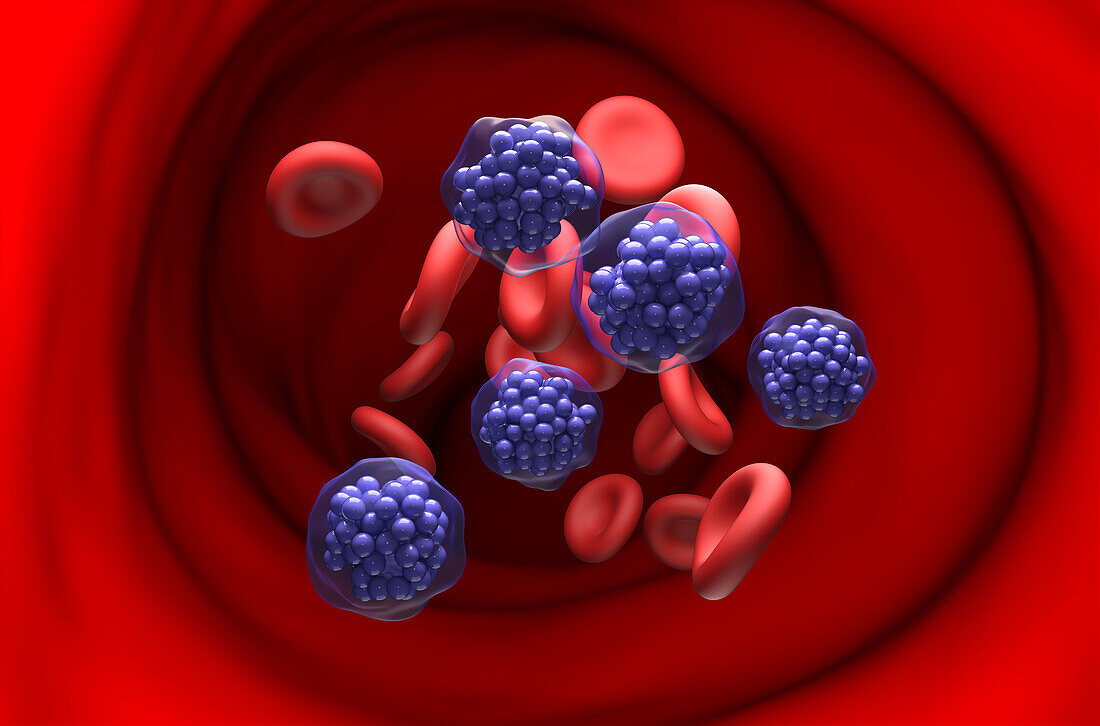 Diffuse large B-cell lymphoma, illustration