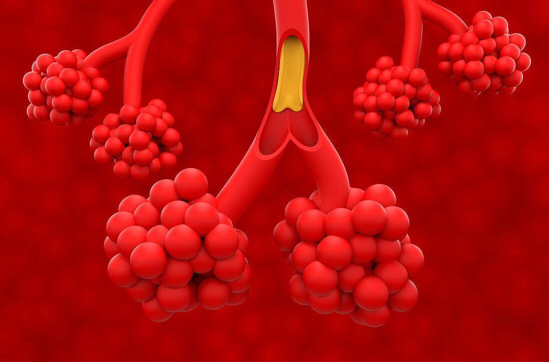 Cystic fibrosis, illustration