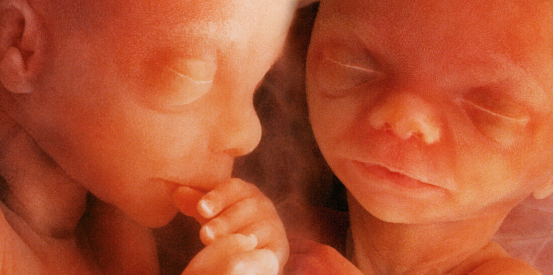 Twin foetuses