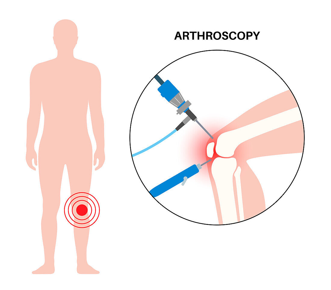 Knee joint arthroscopy, illustration