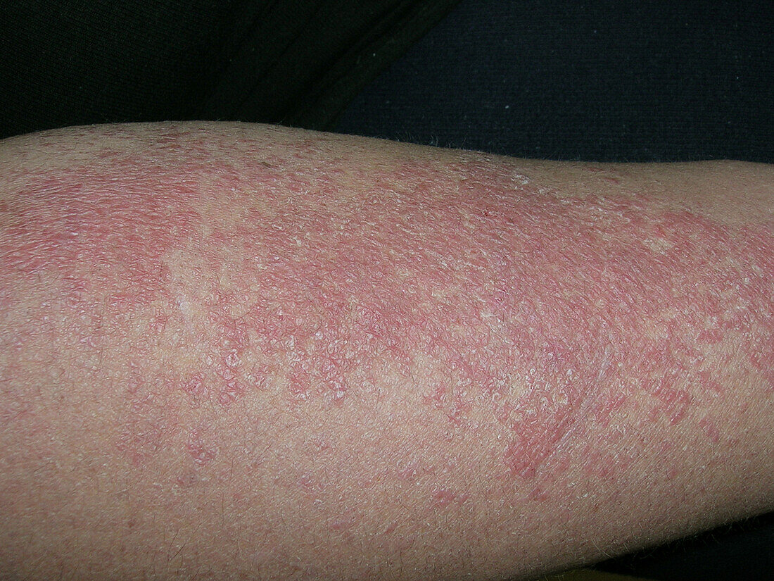 Lupus erythematosus