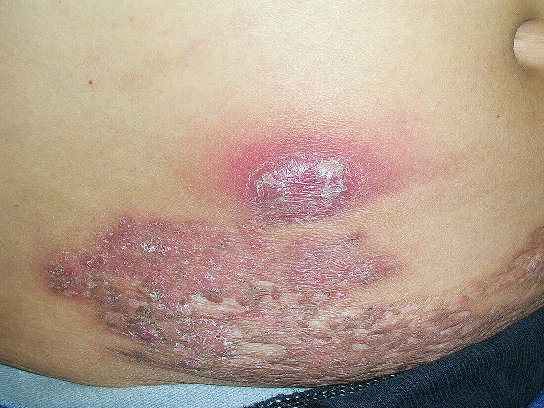 Pyoderma gangrenosum being treated with adalimumab